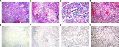 Low expression of H3K27me3 is associated with poor prognosis in conventional chordoma